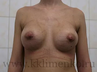 Фото через 15 дней после операции аугментации