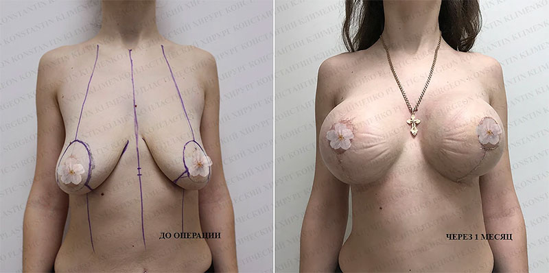 Вертикальная мастопексия. Фото до и через 1 месяц после подтяжки груди с установлением имплантатов