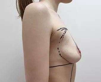 Фото перед операцией увеличения груди