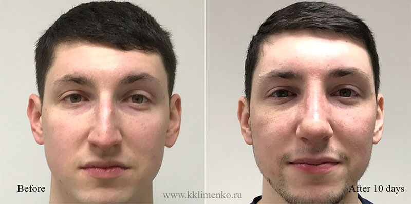 Фото до и после после операции
