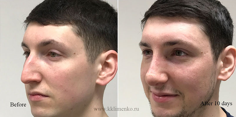 Фото до и после после операции