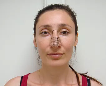 Пациентке сделана предварительная разметка носа