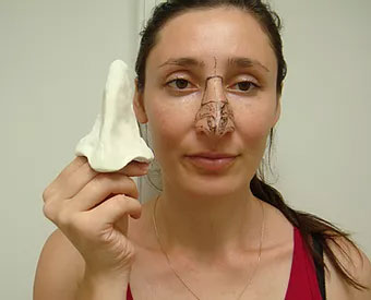 Пациентка с 3D-макетом носа