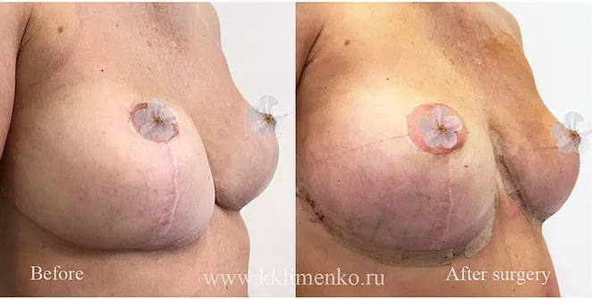 Коррекция мастопексии. Выпадение имплантатов молочных желез Bottoming Out