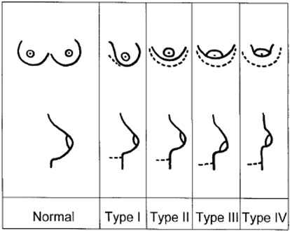 Классификация тубулярной деформации груди