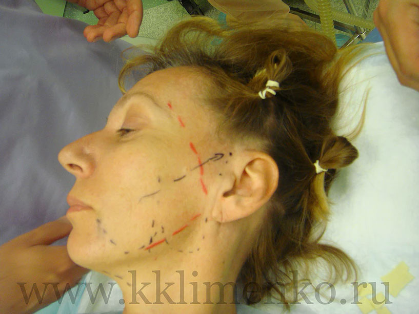 Разметка на коже, проекция лицевого нерва