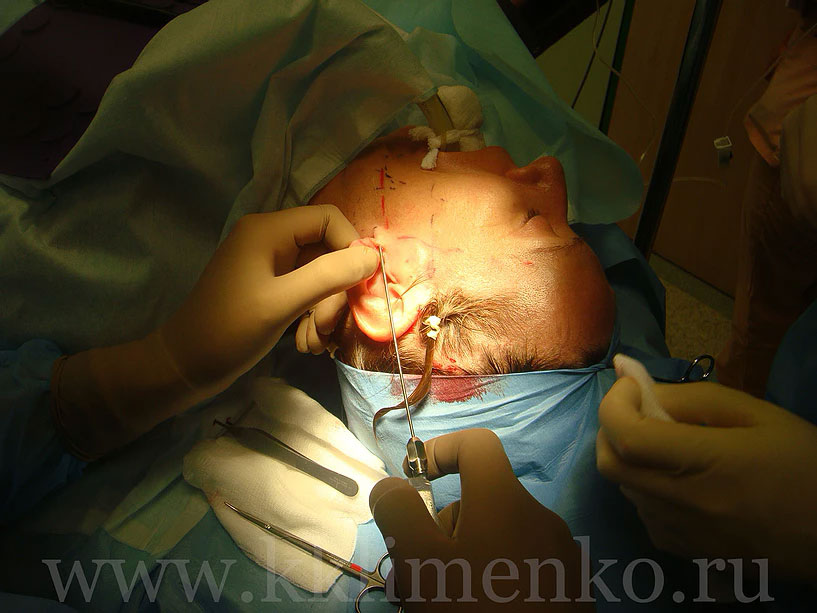 Инфильтрация мягких тканей лица раствором анестетика